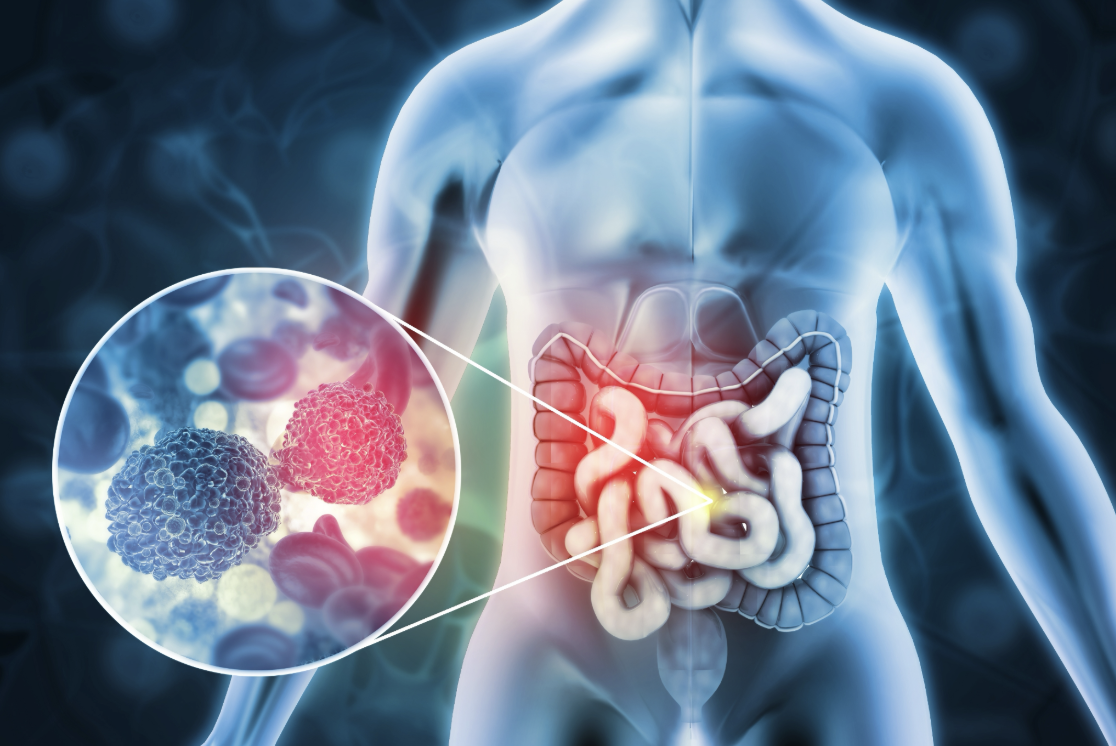 Colon Cancer: The Dangerous Threat Creeping Up on the Younger Generation