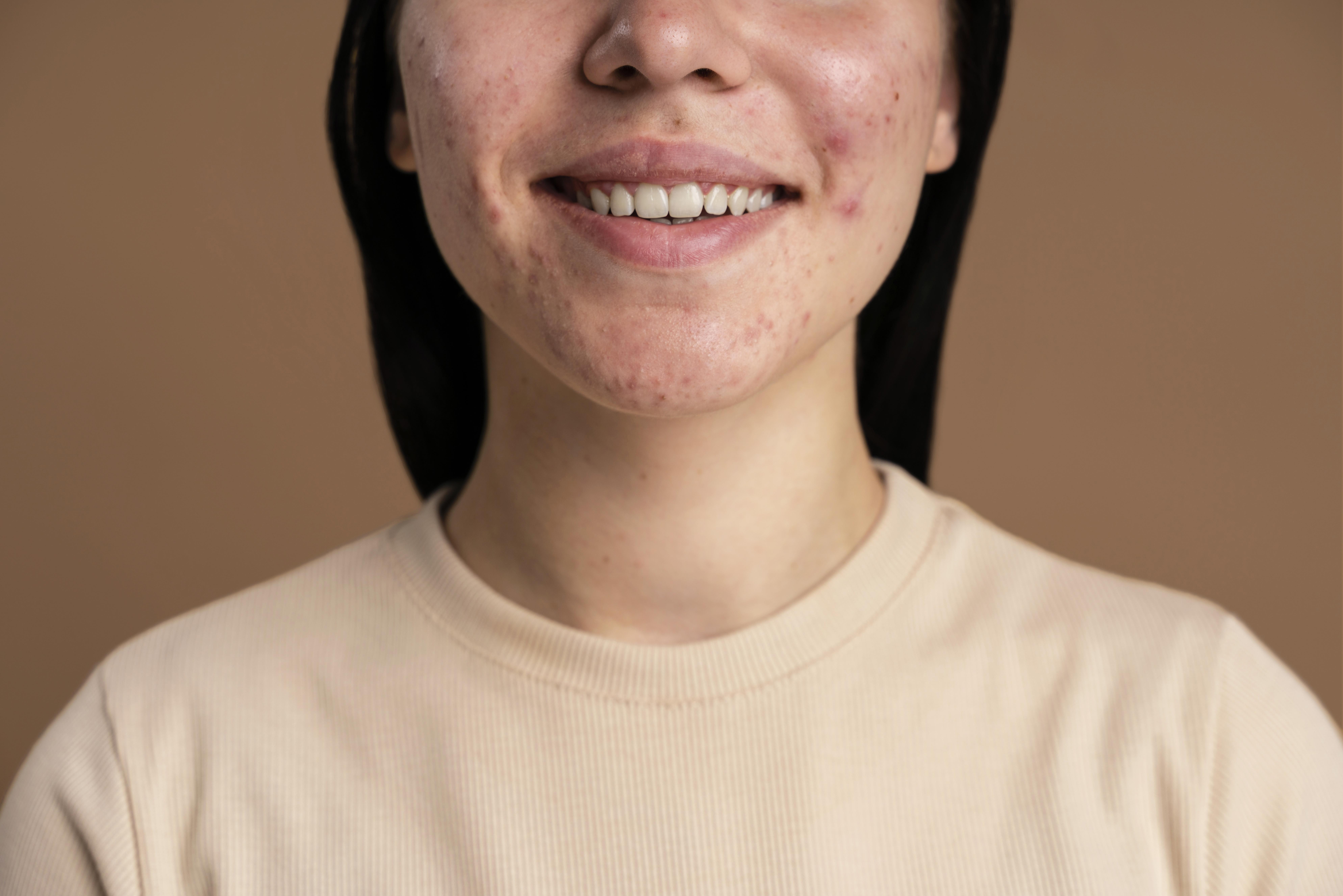 Ten Acne Myths That Deserve to Be Cancelled